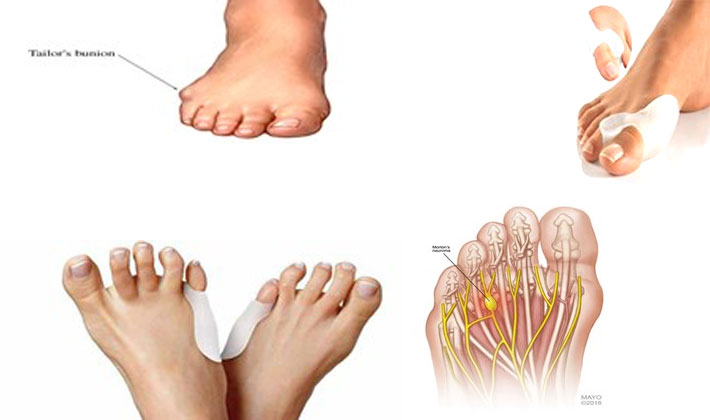 Pinching feeling between your toes or under your foot? Here's why.