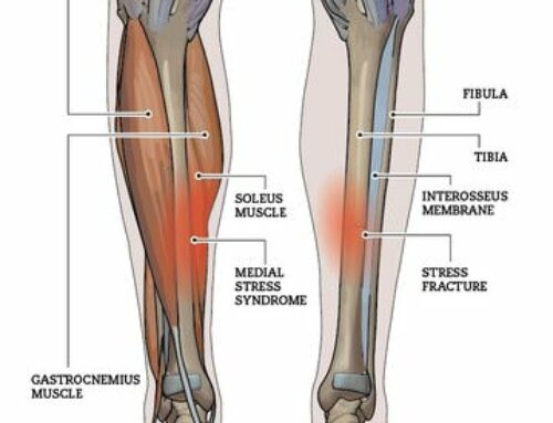 Case Study – Medial Tibial Stress Syndrome