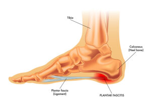 Plantar Fasciitis